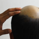 BPH, Balding, and Finasteride - Sperling Prostate Center